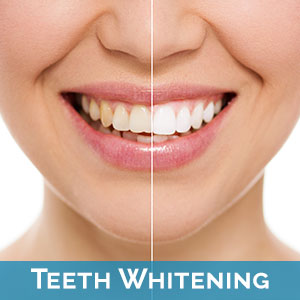 Teeth Whitening Mission Viejo